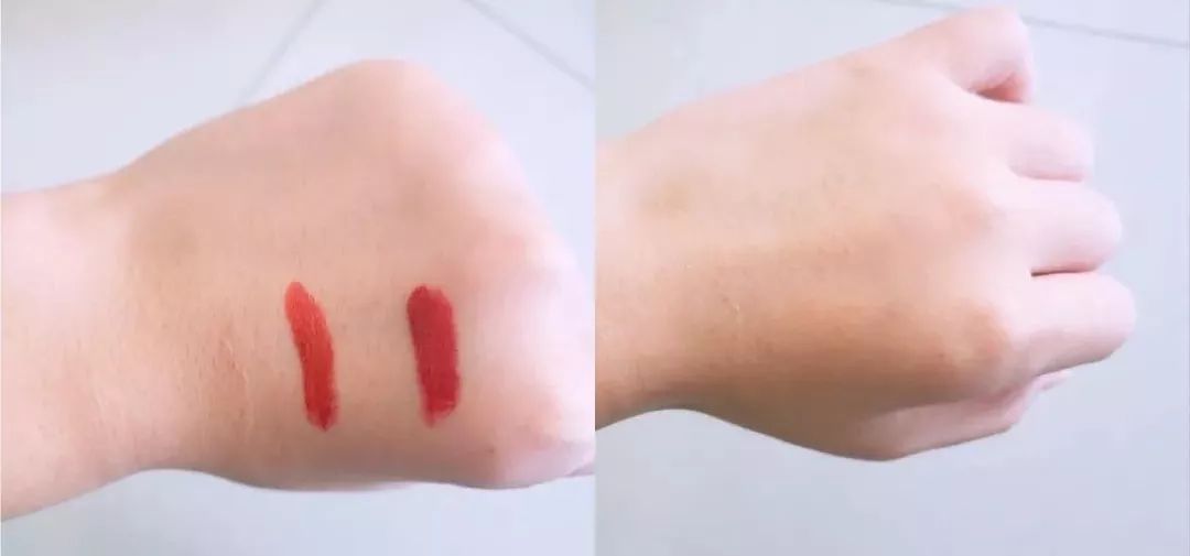 挤痘痘出来的白色长条状是什么,痘痘黑头挤出白颗粒