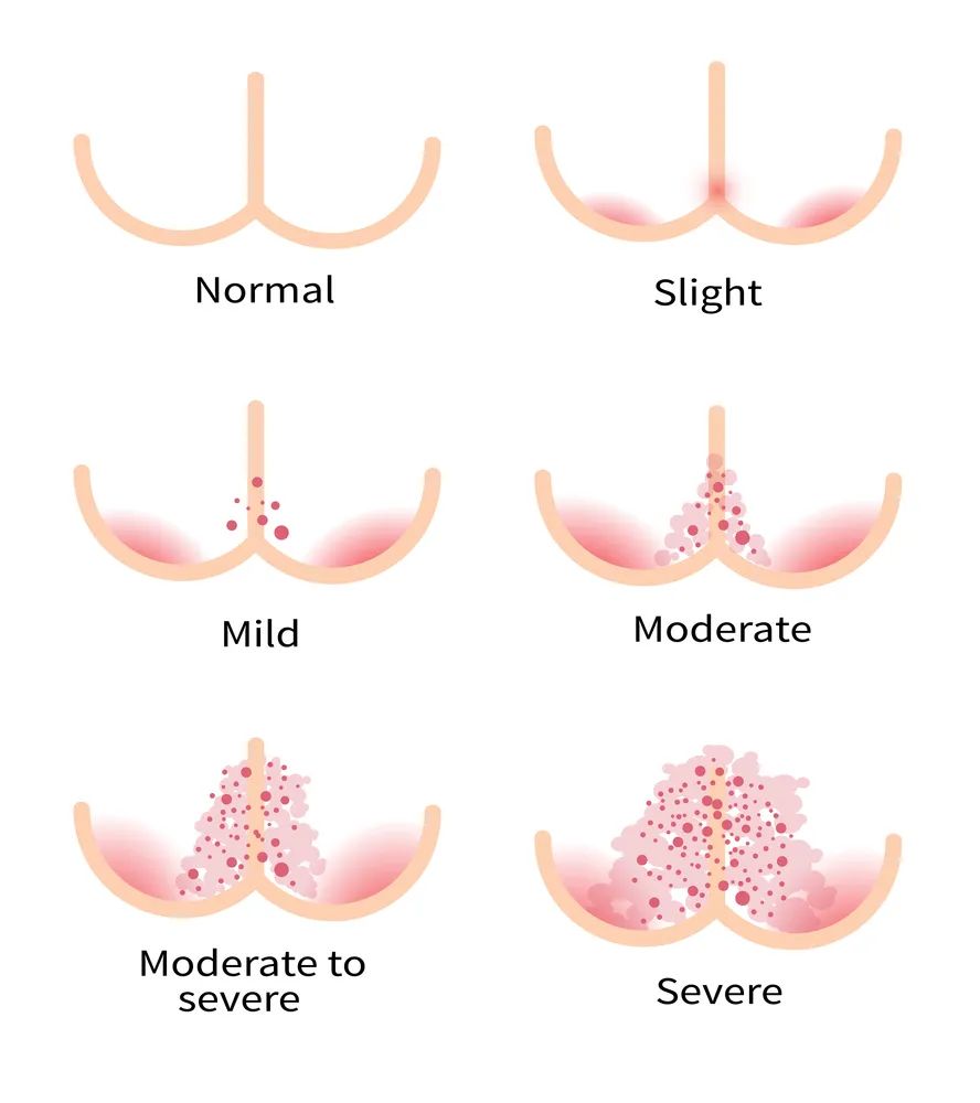 老人说天热了别用尿不湿了怎么说,老人不肯穿尿不湿晚上小便怎么办