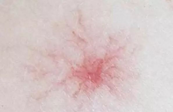 【注意】千万别大意！身上有这种小红痣，很可能是大病的预警信号…