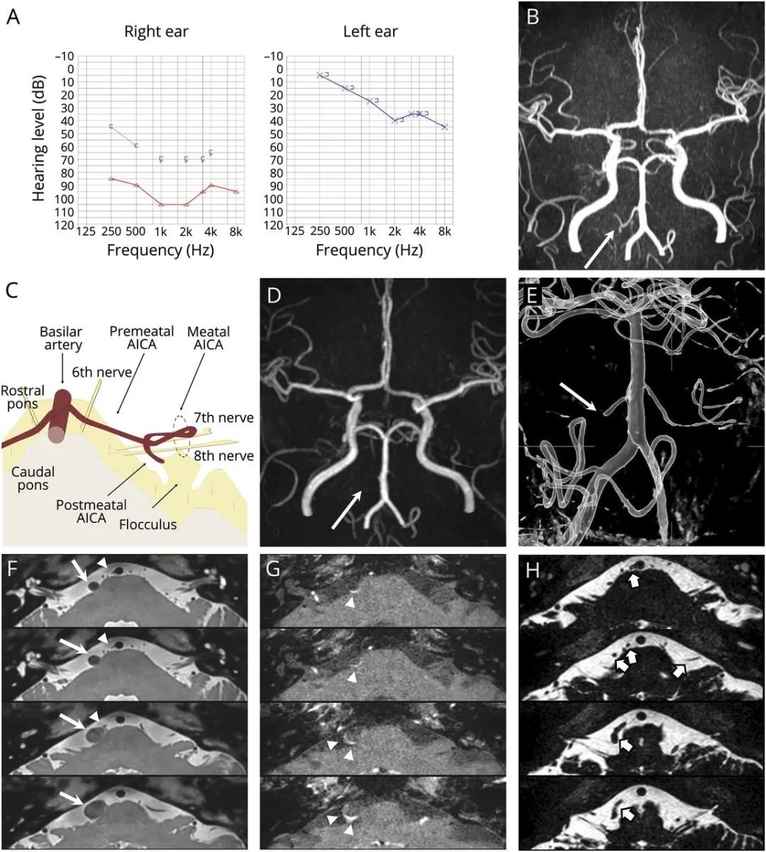 眩晕右耳听力突然弱是怎么造成的,眩晕听力下降是什么原因