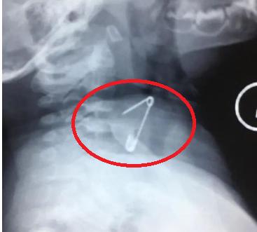 一岁男童吞别针,小孩误吞异物到食道怎么办