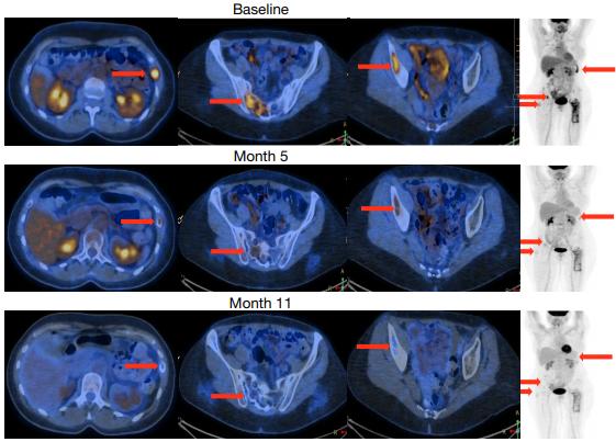 《自然》:模拟禁食或是治疗乳腺癌的“神助攻”!科学家发现模拟禁食能增强乳腺癌内分泌治疗疗效,延缓耐药的机制丨科学大发现