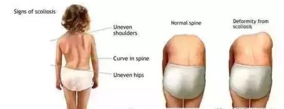 孩子弯腰驼背高低肩,孩子弯腰驼背体态难看