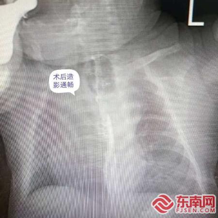 漳州新生儿先天性食道闭锁,先天性食道闭锁宝宝