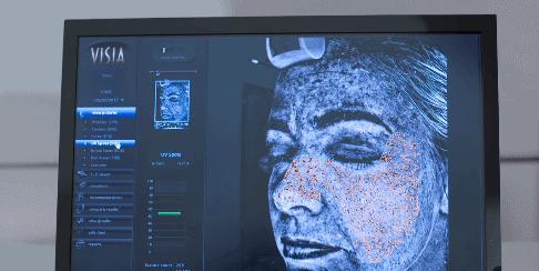 花了3万做激光,才彻底懂了:医生为什么劝你别去斑