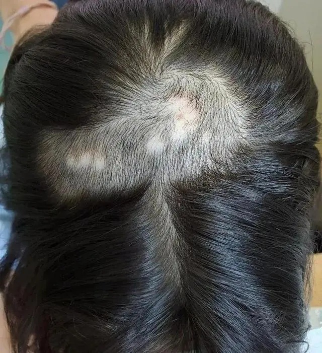 杭州六年级男孩出现斑秃医生：学习压力大