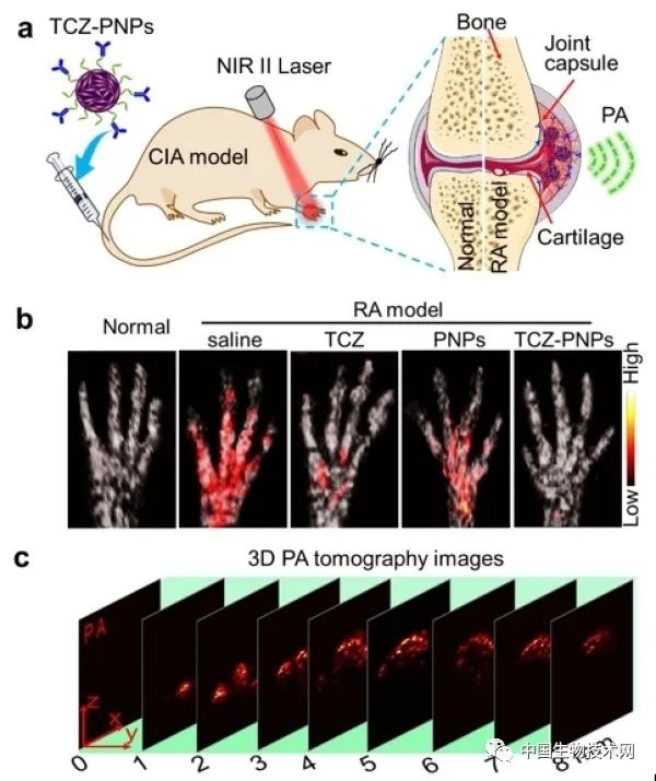 深圳市治疗类风湿的医院,深圳市类风湿性关节炎治好案例