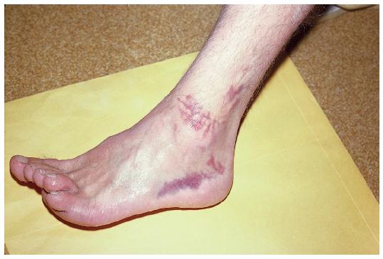 踝关节损伤的处理7条助你应对,踝关节损伤恢复的阶段表现发痒