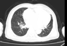 新冠肺炎引起冠心病,新冠医案