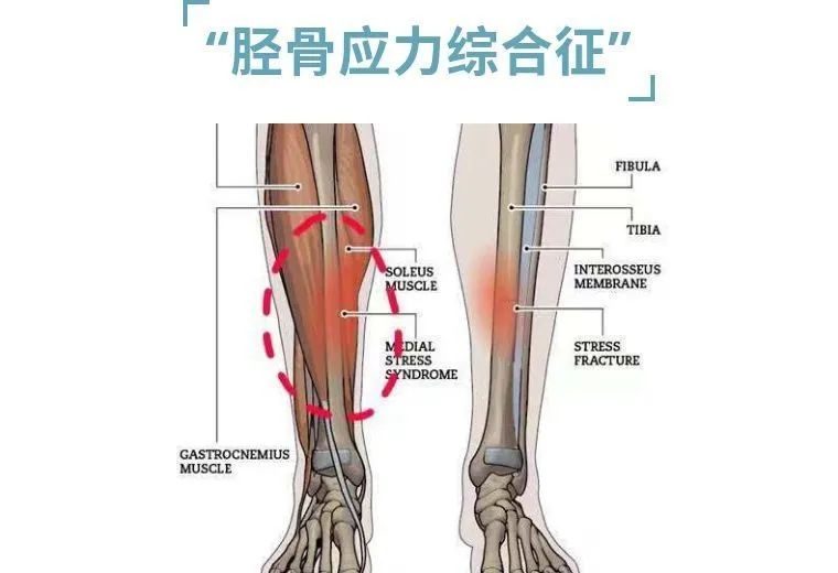小腿“迎面骨”疼？快来康康！