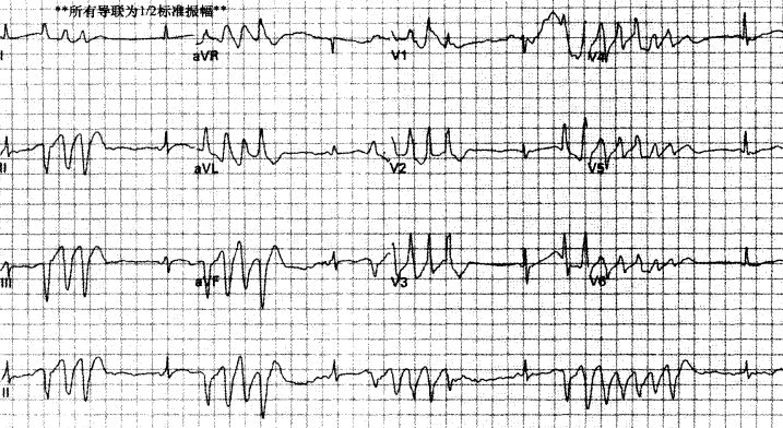 室速全名叫什么,室速的解读和识别