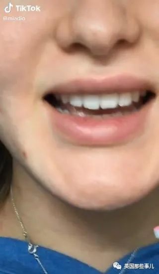 外网年轻人流行用指甲锉磨牙正畸,把正经牙医都急坏了