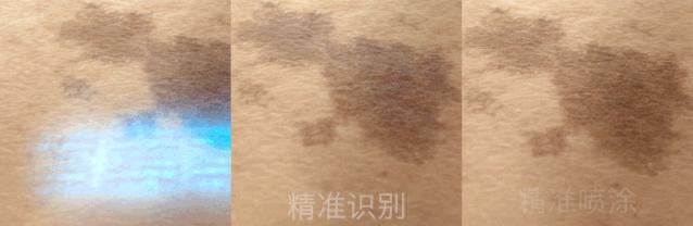 去斑点最有效方法医美去除斑痕,脸上暗沉有斑点可以做什么医美