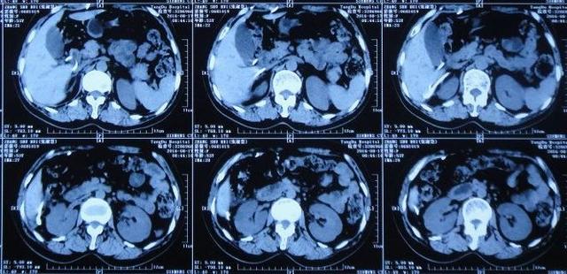 脑积水腹腔分流术后头晕头痛,脑积水分流术后发烧会有什么后果