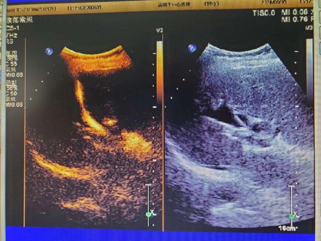 超声介入胆管引流,超声引导下胆道置管引流