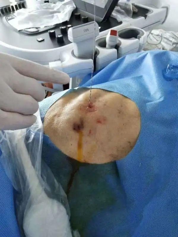 超声介入胆管引流,超声引导下胆道置管引流