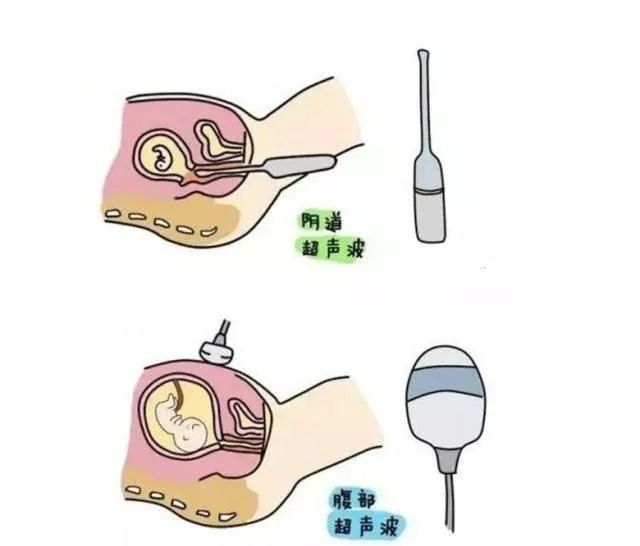 小排畸是腹超还是阴超,彩超是阴超还是腹超