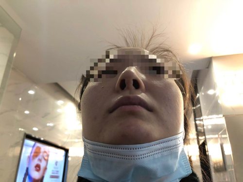 西安一女子隆鼻花费近5万,西安一女子花四万元整形