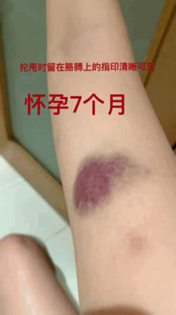 张培萌妻子谈被家暴,张培萌妻子首谈家暴细节全视频