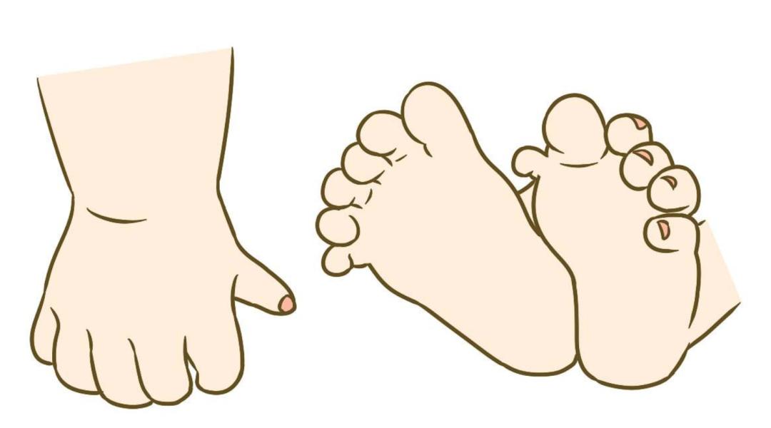 小孩长了6根手指怎么办,婴儿长出多根手指
