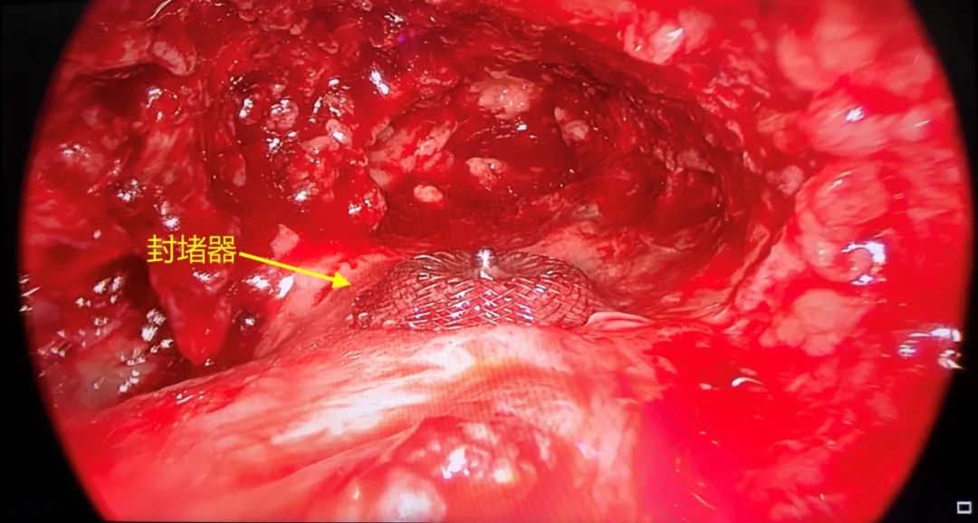 用他自己的肌肉塞进胸腔？甘肃农民为治病跨越大半中国，最终在杭州得救
