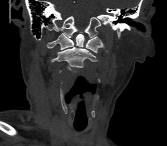 北京友谊医院微创外科,北京友谊医院骨科微创手术