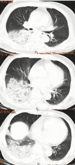 支原体肺炎症状应该注意什么,支原体肺炎这些症状要警惕