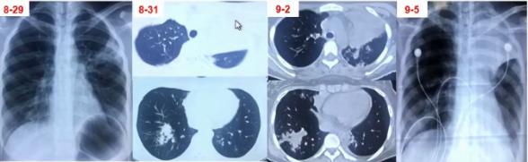 支原体肺炎症状应该注意什么,支原体肺炎这些症状要警惕