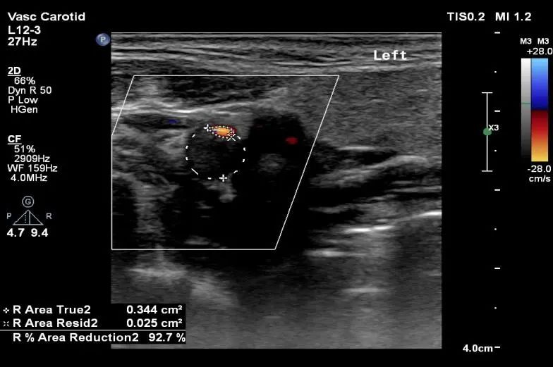 缺血性卒中颈血管超声检查完成率,颈动脉超声脑卒中