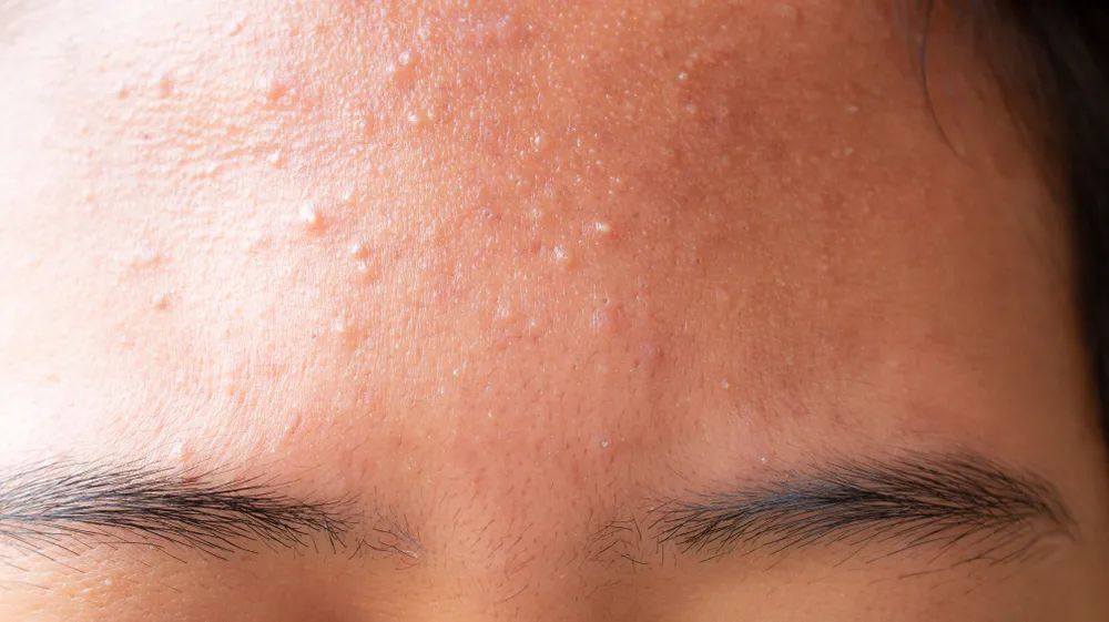 额头上因为什么原因会反复起闭口,额头反复长闭口可以挤吗