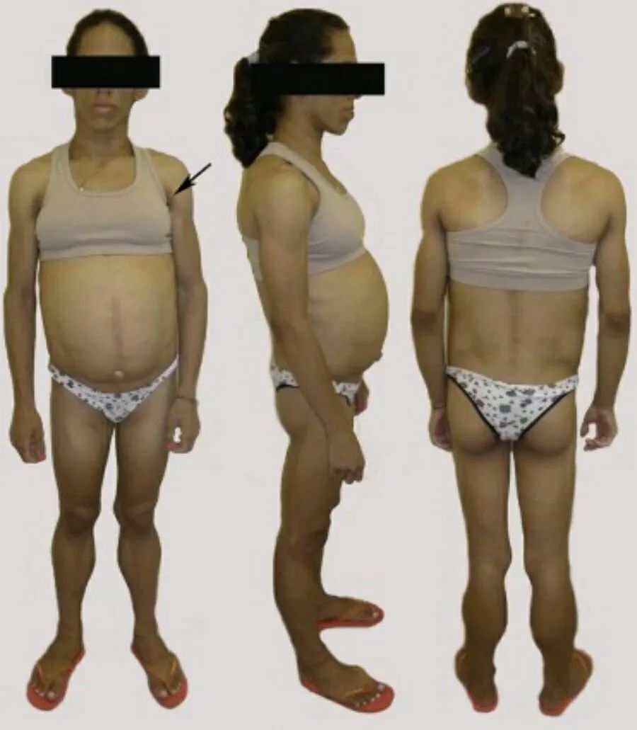 先天性全身性脂肪营养不良,先天性肌营养不良