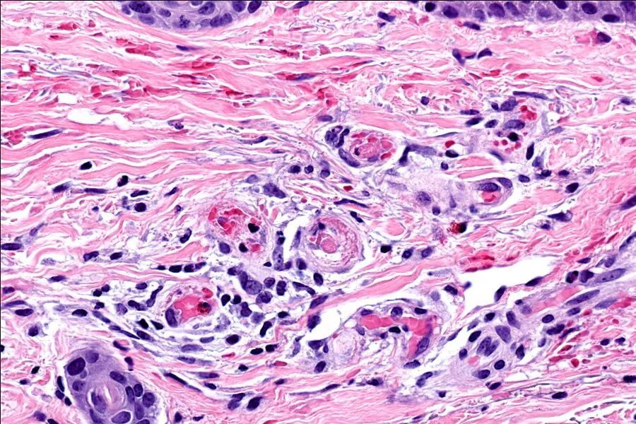 小腿处出现局部皮肤溃疡的症状,小腿下肢溃疡治疗要多久