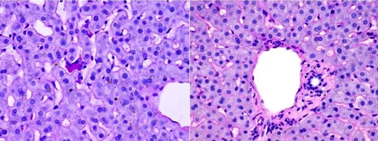 黄疸反反复复要怎么查原因,黄疸反反复复出现