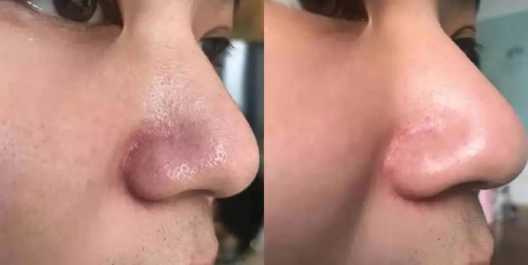 痘痘挤出的白米粒是什么,痘痘挤出来的白色乳浆是什么