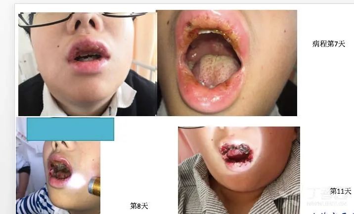 中医啄治法治疗扁桃体反复化脓,扁桃体化脓低烧不退是怎么回事