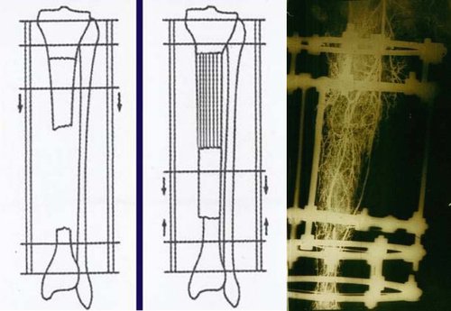 为什么说糖尿病尽量不要截肢,糖尿病足后期一定要截肢吗