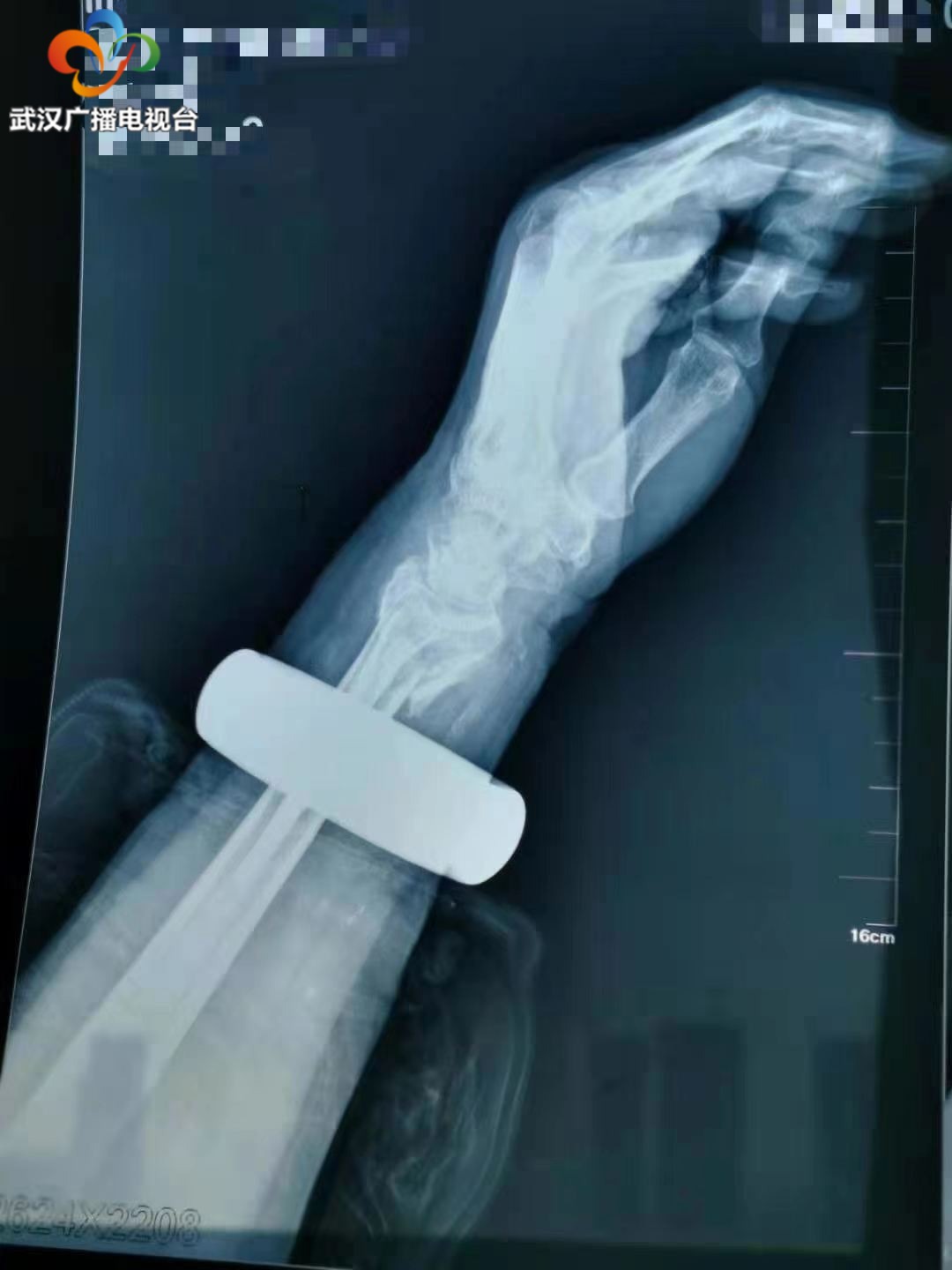 婆婆手腕骨折,手骨太硬手镯取不下来怎么办