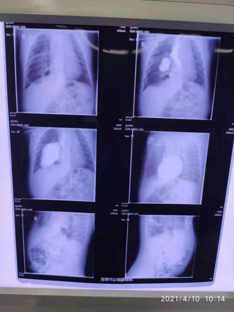 腹腔脏器修补术有哪些,腹腔探查手术戳孔位置