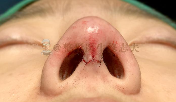 鼻综合整形切口,鼻综合切口处愈合几率