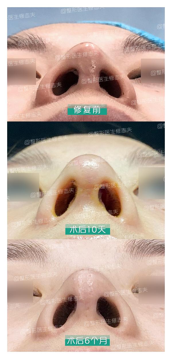 鼻综合整形切口,鼻综合切口处愈合几率