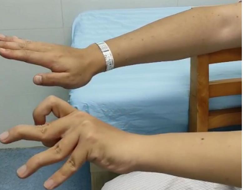 “痉挛性脑瘫”幼时失治，20年后矫正“畸形”解病痛