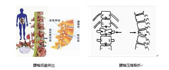 引起腰腿痛的原因权威分析,根除腰腿痛的秘方是真的吗