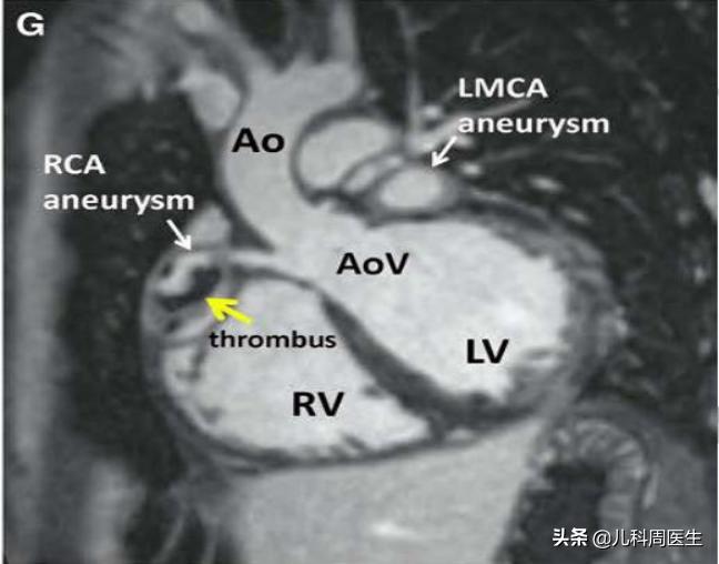 川崎病的孩子为啥容易感冒,怎样确诊儿童得了川崎病