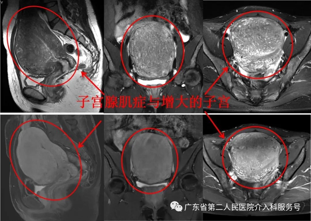 49岁腺肌症痛经月经量大怎样治疗,子宫腺肌症子宫增大痛经不明显