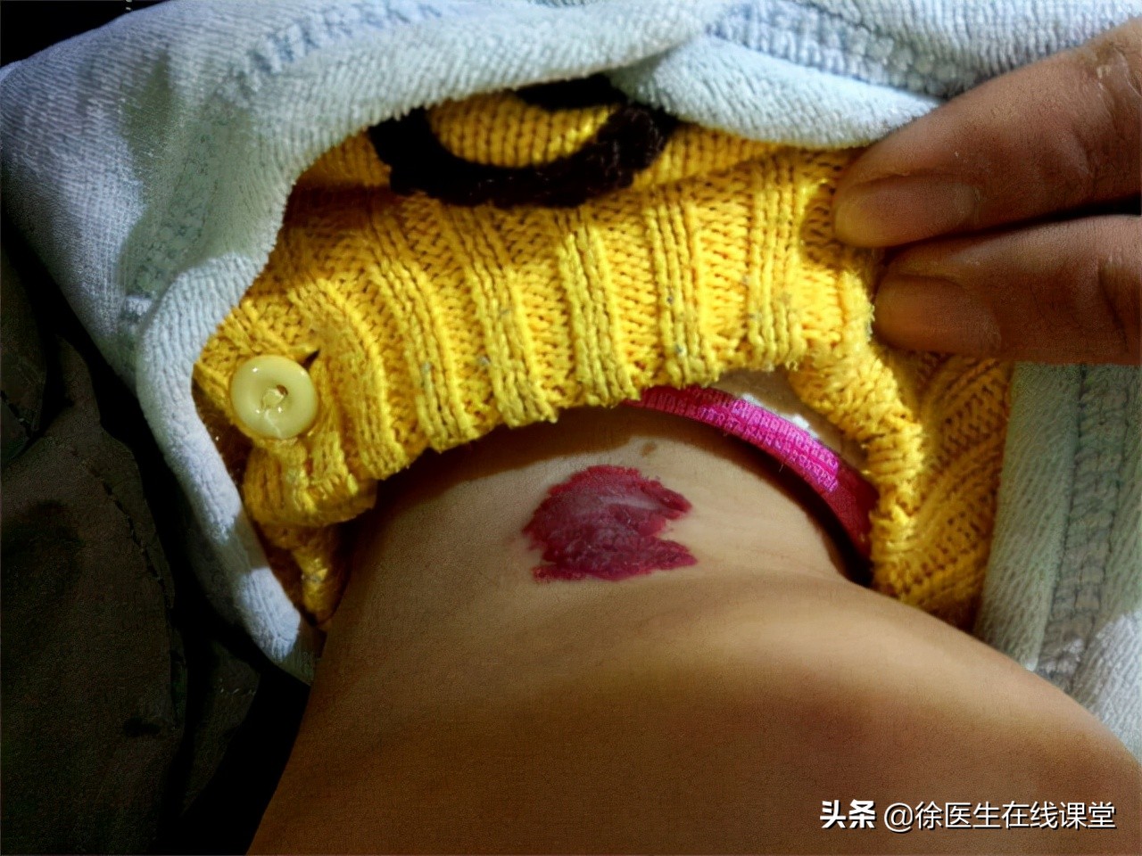 海绵状血管瘤遗传有没有方法检测,海绵状血管瘤会遗传给下一代吗