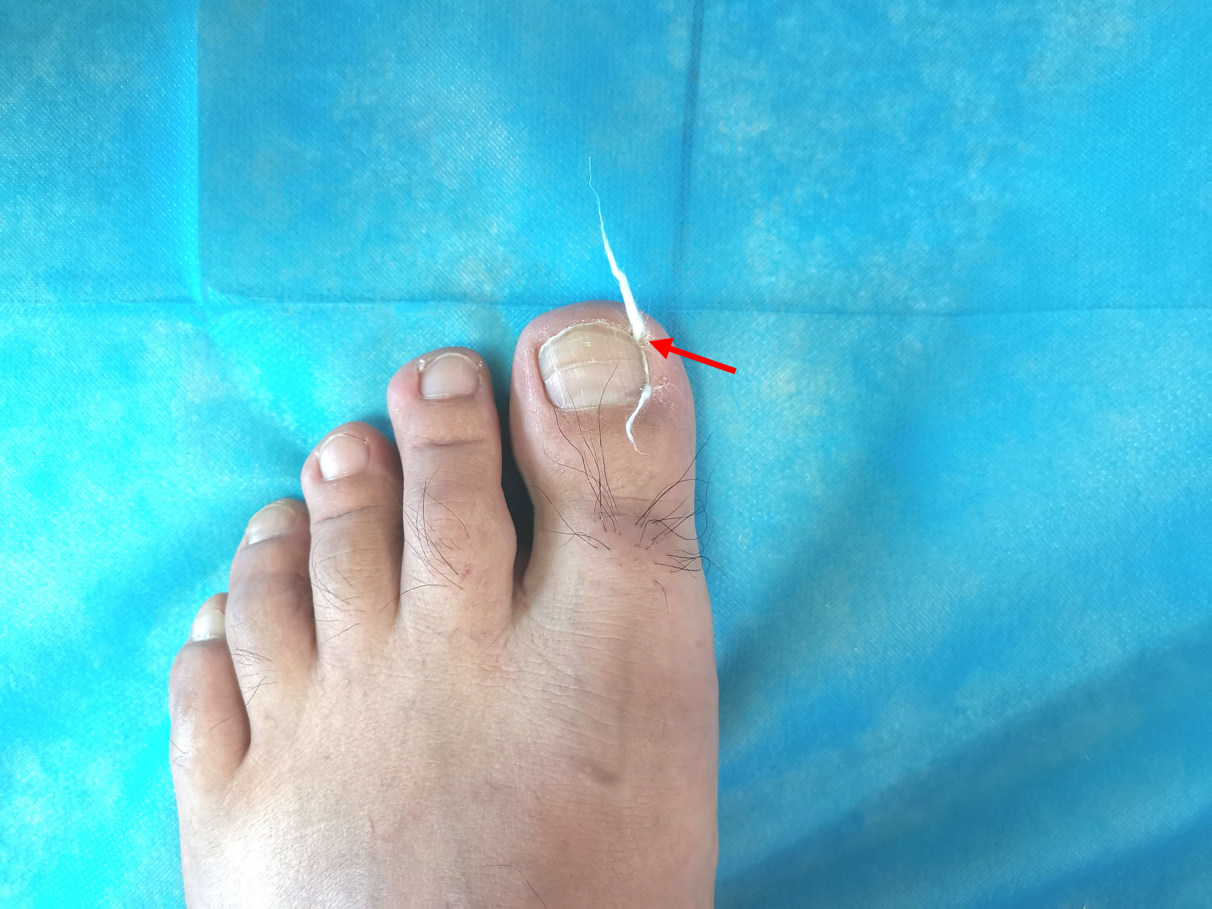 怎么用棉花治疗甲沟炎,严重甲沟炎用棉花塞有用吗