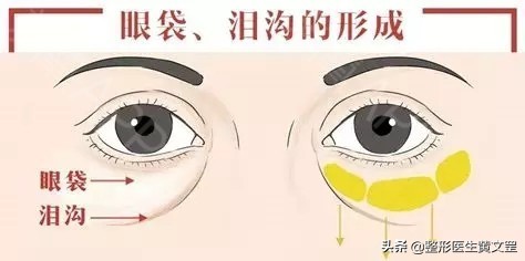 有了泪沟显老怎么办,有没有办法解决后天泪沟