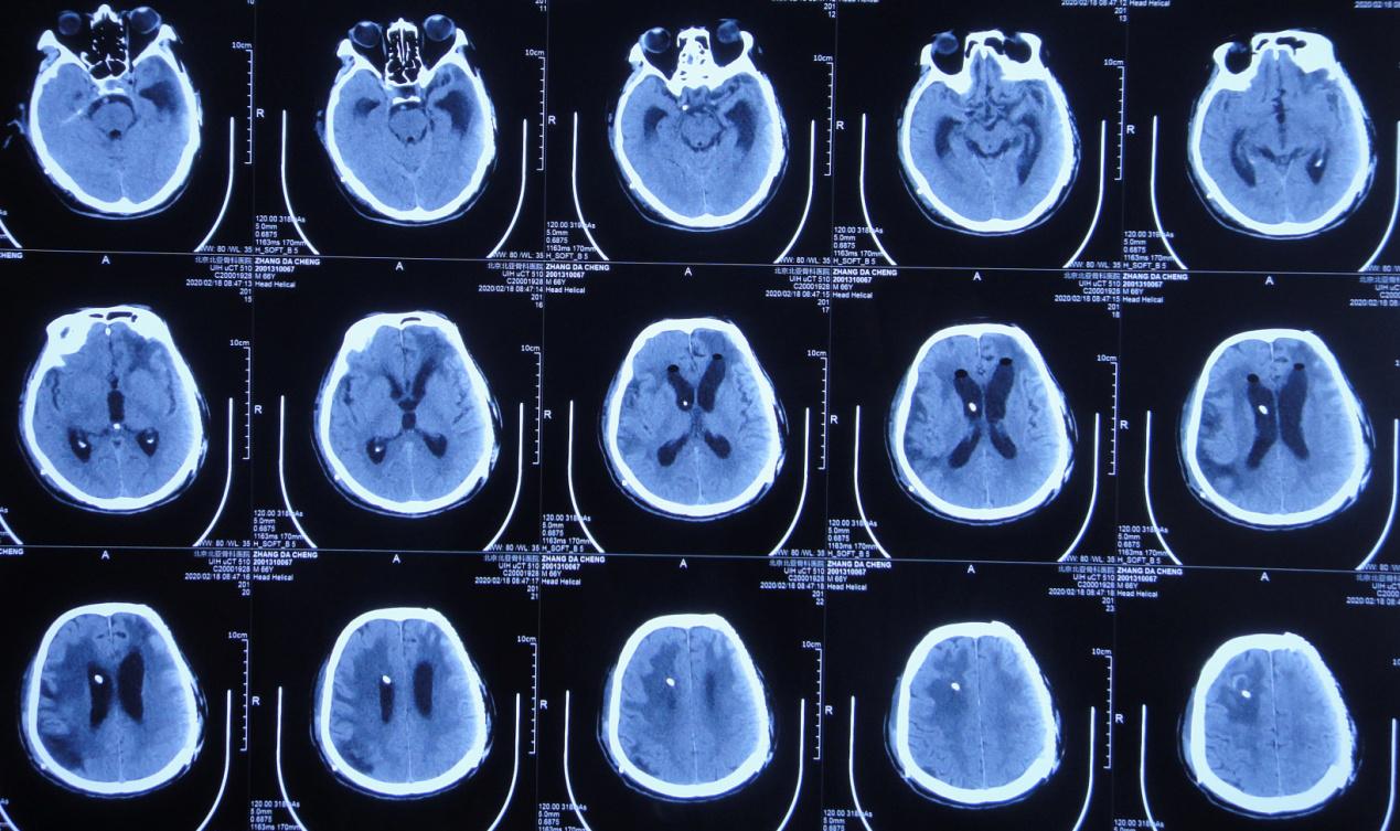 颅脑外伤术后脑积水,脑外伤脑积水颅骨缺失