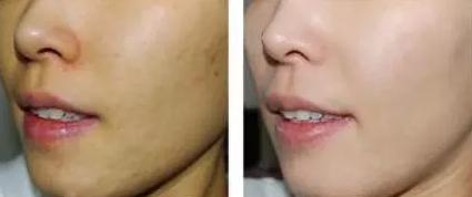 激光美白皮肤大概需要多少钱,私密激光美白多久能见到效果