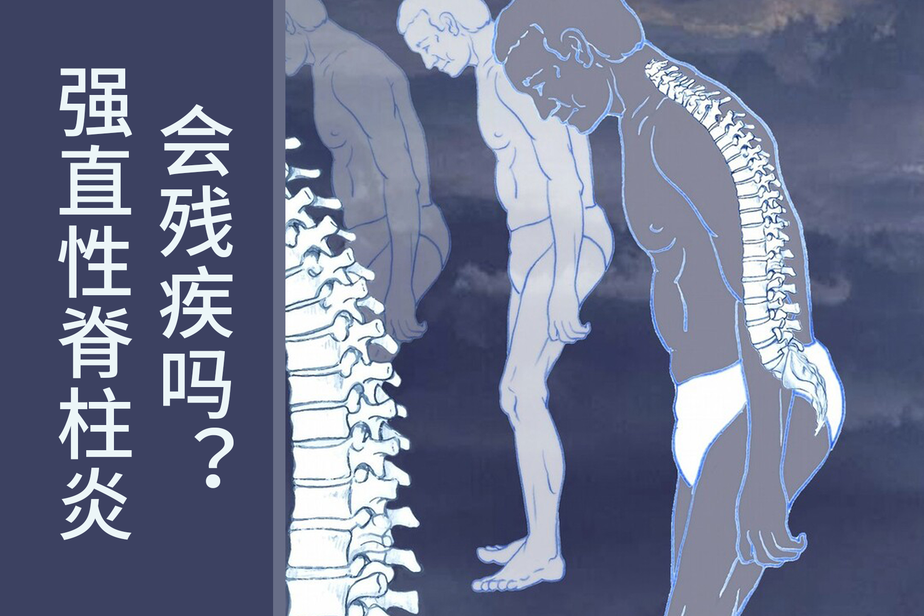 强直性脊柱炎多大几率残疾,强直性脊柱炎不治疗多久会驼背